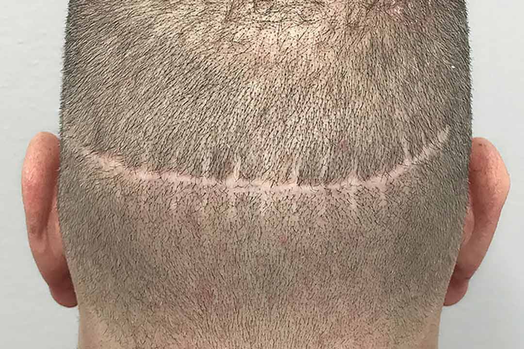 arr-Tvärs över huvudet som uppkommit efter en hårtransplantation med den föråldrade tekniken FUT