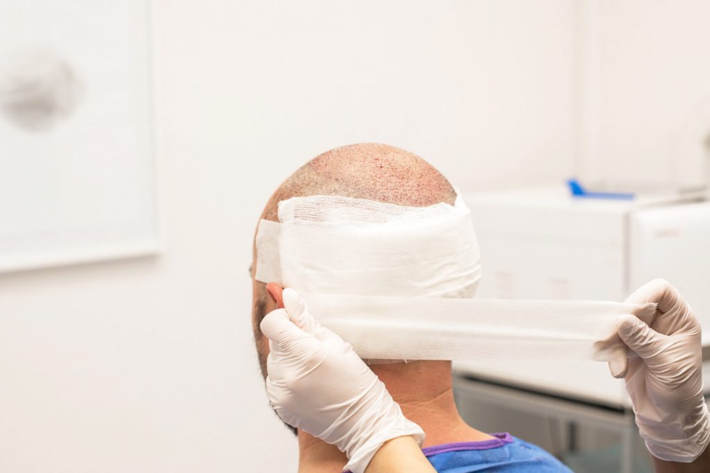 Bandage applied by hair technicians over donation area
