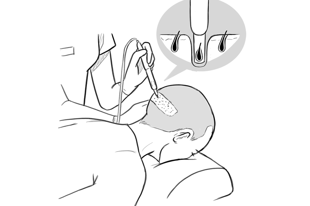 Illustration på hårtekniker som plockar ut hårsäckar ur patientens bakhuvud