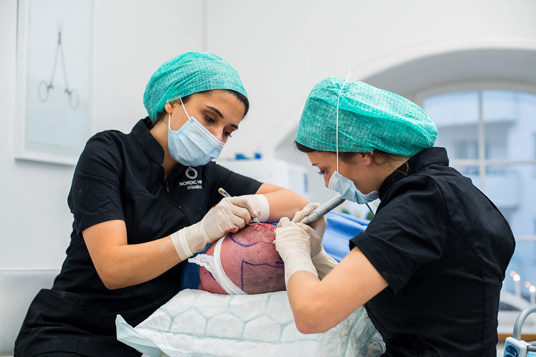 Patient genomgår hårtransplantation med FUE metoden
