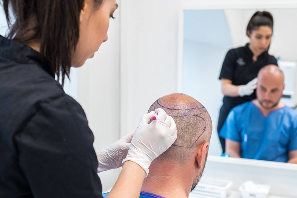 Transplantation area is drawn before hair transplant