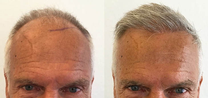 Before and after picture of a man with grey white hair after a hair transplant