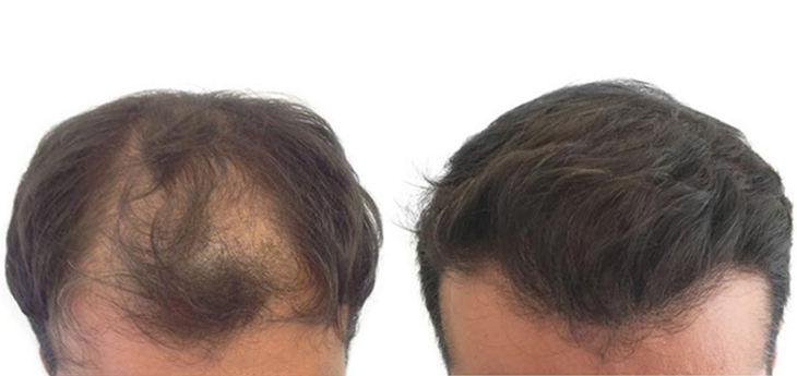 Before and after results photo a man middle aged with strong hair loss in crown