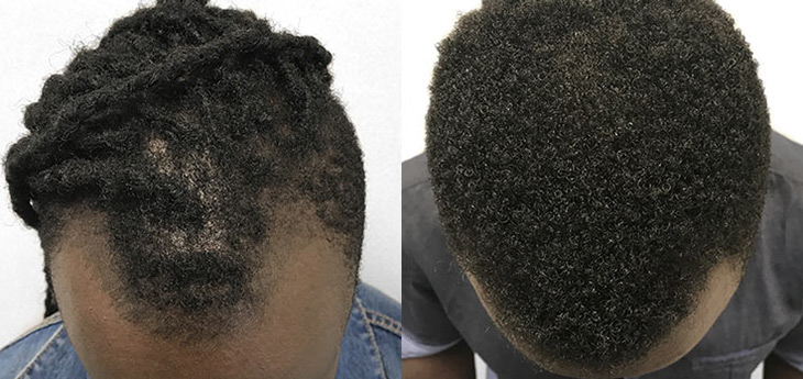 Results of a hair transplant on a man with African hair