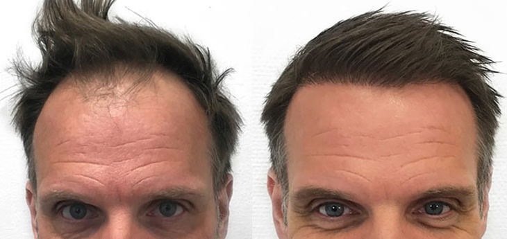 Results of hair transplant on a middle aged man with dark brown hair