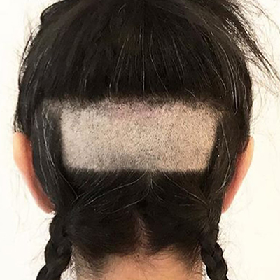 A shaved square on the back of the head where grafts are to be harvested on female patient