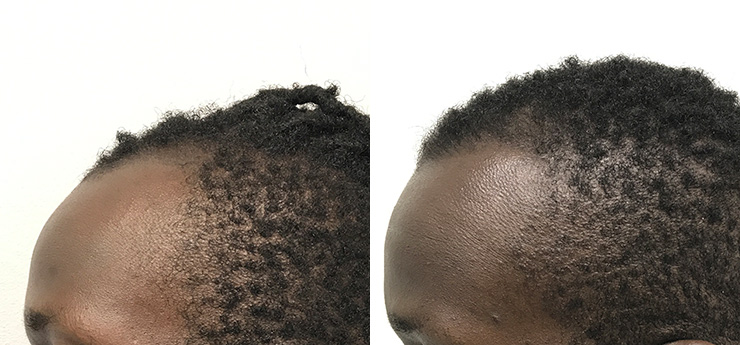 Before after from side man with african hair after hair transplant 1400 grafts