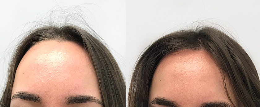Before after woman hair transplant of 2000 grafts