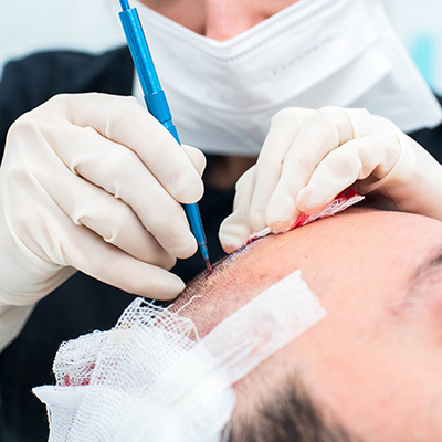 Hair technician creates channels in scalp where hair follicles are to be placed