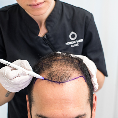 The process of an operation with FUE technology | Nordic Hair