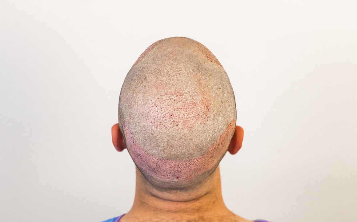 Head of a patient directly after hair transplant