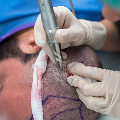 Micro drill loosens hair follicles before extraction