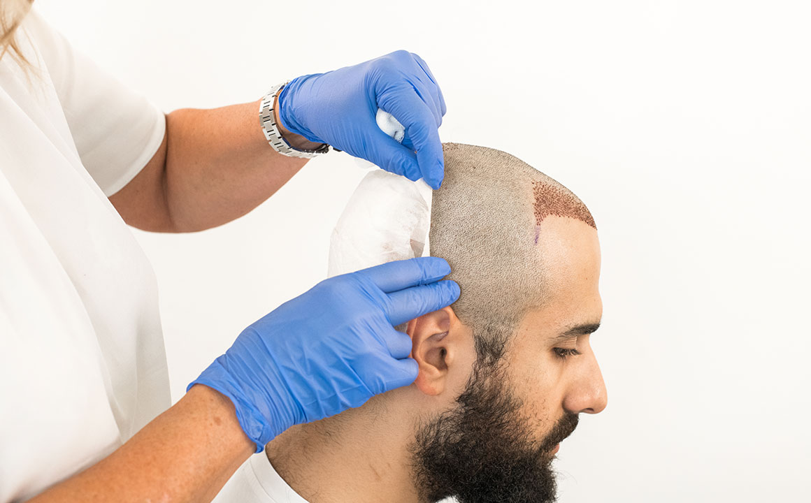 How to remove bandage after a hair transplant | Nordic Hair