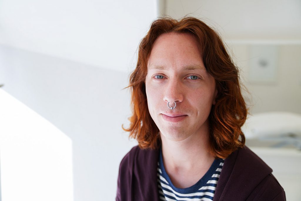 Portrait of patient who undergone hair transplant to make hairline more feminine